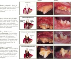 Stages of periodontal disease